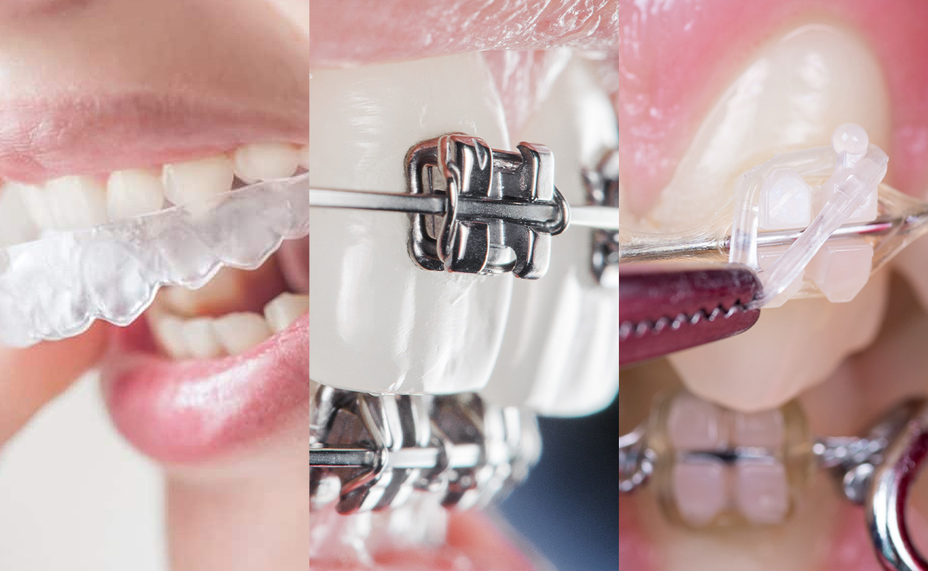 Orthodontic Treatment