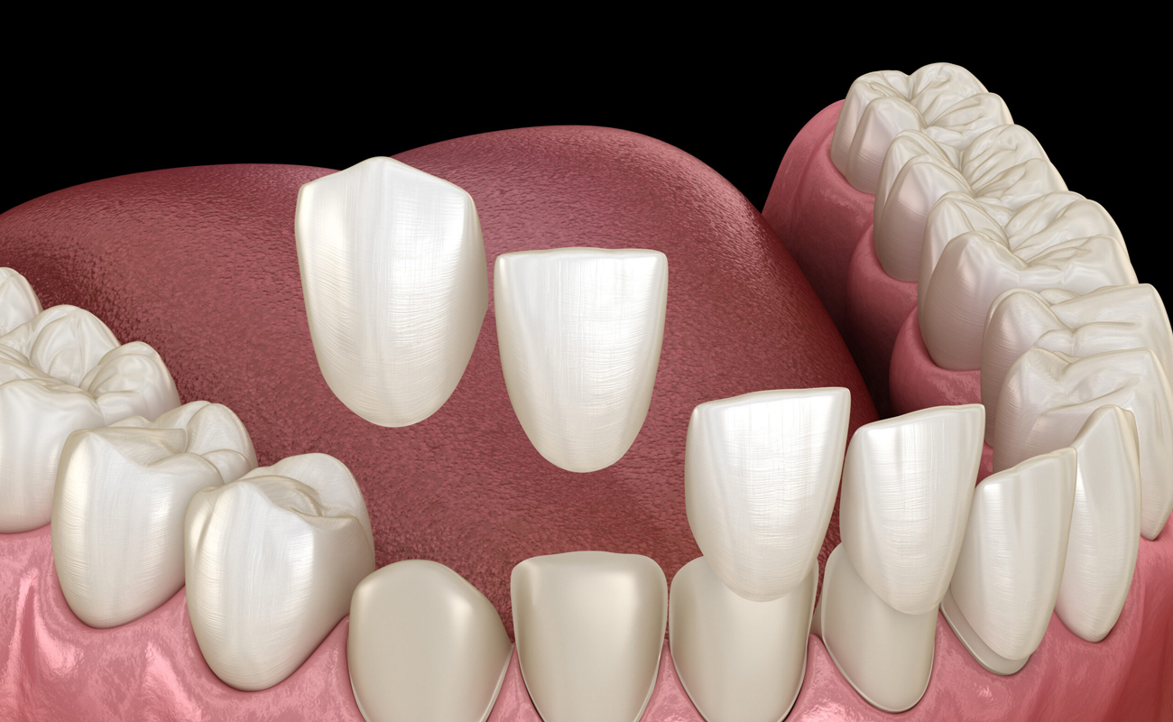 Full Mouth Rehabilitation